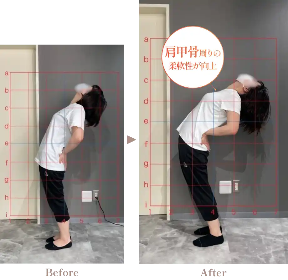 肩甲骨回りの事例写真